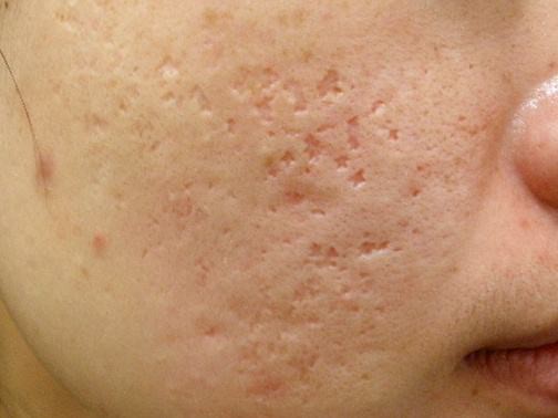 最新痘坑撫平神器，科技重塑肌膚之美，自信生活從此開始