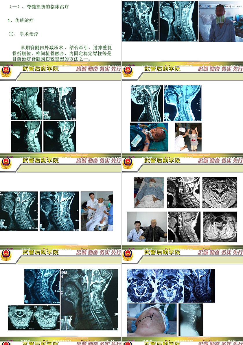 2023年脊髓損傷研究新進展，里程碑式的突破與日常奇妙變化